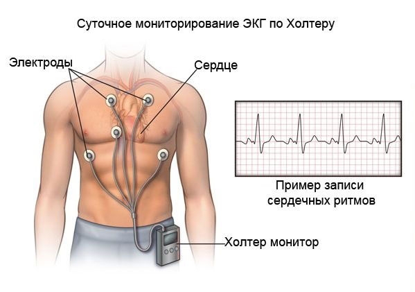 Суточное монирорирование ЭКГ